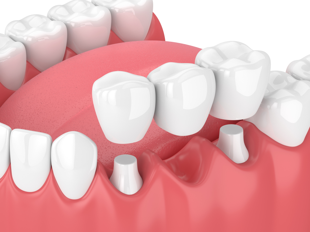 Cosmetic Dental Bridge