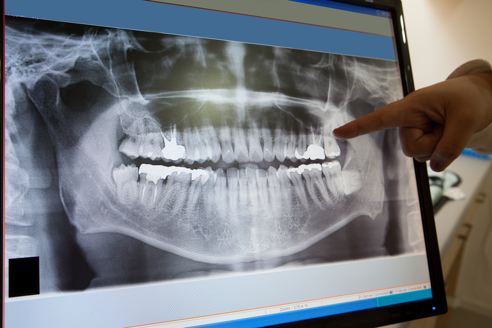 Digital Dental X=Rays