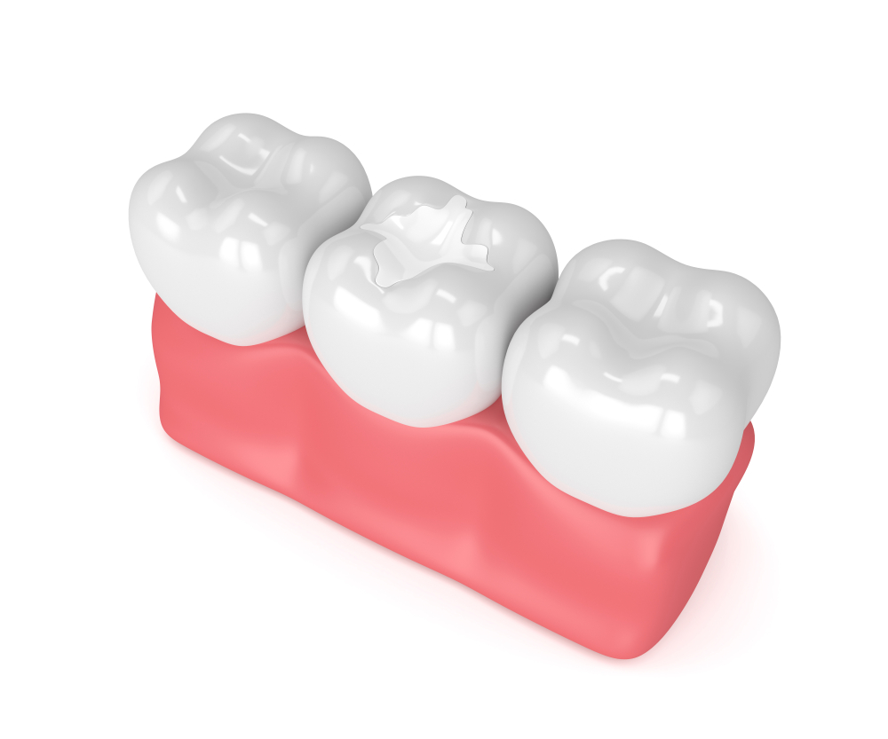 Composite Dental Restorations