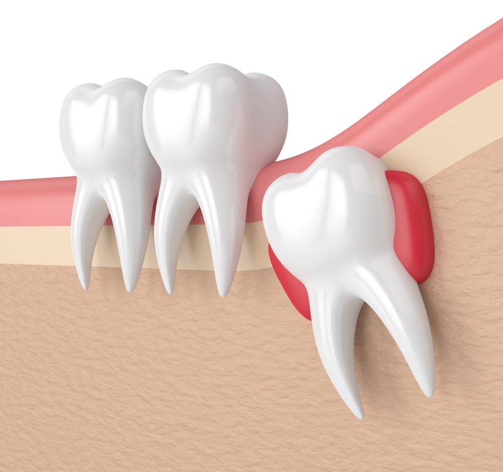 Dental Extractions